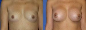 Schoemann Plastic Surgery Breast Augmentation Patient 4-1