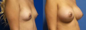 Schoemann-Plastic-Surgery_Encinitas_breast-augmentation-patient-4-2