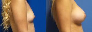 Schoemann-Plastic-Surgery_Encinitas_breast-augmentation-patient-4-3