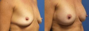 Schoemann-Plastic-Surgery_Encinitas_breast-augmentation-patient-5-2