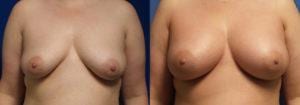 Schoemann-Plastic-Surgery_Encinitas_breast-augmentation-patient-6-1