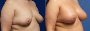 Schoemann-Plastic-Surgery_Encinitas_breast-augmentation-patient-6-2