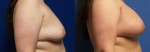 Schoemann-Plastic-Surgery_Encinitas_breast-augmentation-patient-6-3