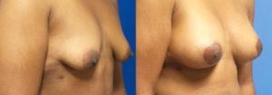 Schoemann-Plastic-Surgery_Encinitas_breast-augmentation-patient-7-2