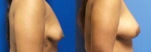 Schoemann-Plastic-Surgery_Encinitas_breast-augmentation-patient-7-3