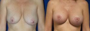 Schoemann-Plastic-Surgery_Encinitas_breast-augmentation-patient-8-1