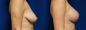Schoemann-Plastic-Surgery_Encinitas_breast-augmentation-patient-8-3