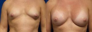 Schoemann-Plastic-Surgery_Encinitas_breast-augmentation-patient-9-1