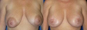 Schoemann-Plastic-Surgery_Encinitas_breast-revision-patient-1-1