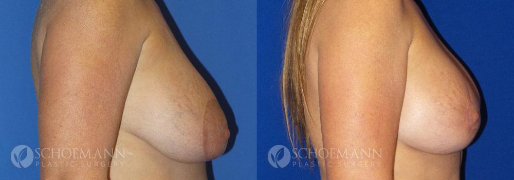 Schoemann-Plastic-Surgery_Encinitas_breast-revision-patient-1-3