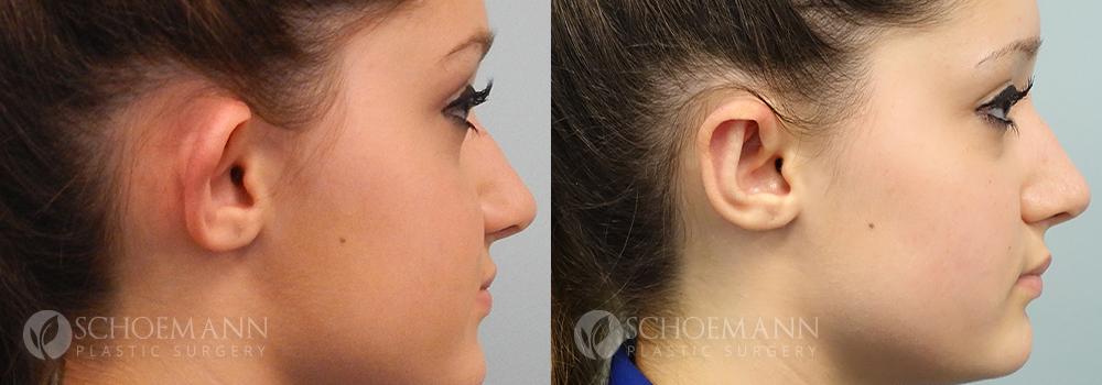Schoemann-Plastic-Surgery_Encinitas_ear-surgery-patient-1-2