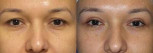 Schoemann-Plastic-Surgery_Encinitas_eyelid-surgery-patient-2-3