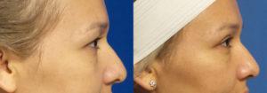 Schoemann-Plastic-Surgery_Encinitas_eyelid-surgery-patient-3-3