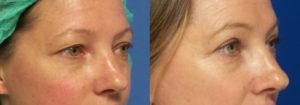 Schoemann-Plastic-Surgery_Encinitas_eyelid-surgery-patient-4-2