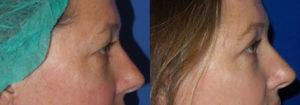 Schoemann-Plastic-Surgery_Encinitas_eyelid-surgery-patient-4-3