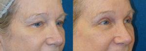 Schoemann-Plastic-Surgery_Encinitas_eyelid-surgery-patient-6-2