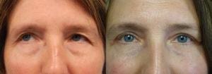 Schoemann-Plastic-Surgery_Encinitas_eyelid-surgery-patient-7-1