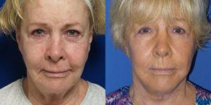 Schoemann-Plastic-Surgery_Encinitas_facelift-patient-1-1