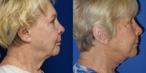 Schoemann-Plastic-Surgery_Encinitas_facelift-patient-1-3