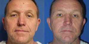 Schoemann-Plastic-Surgery_Encinitas_facelift-patient-2-1