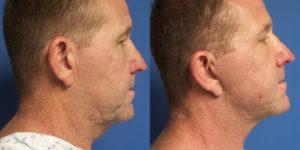 Schoemann-Plastic-Surgery_Encinitas_facelift-patient-2-3