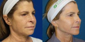 Schoemann-Plastic-Surgery_Encinitas_facelift-patient-3-2