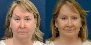 Schoemann-Plastic-Surgery_Encinitas_facelift-patient-4-1