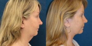 Schoemann-Plastic-Surgery_Encinitas_facelift-patient-4-3