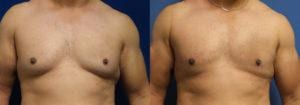 Schoemann-Plastic-Surgery_Encinitas_gynecomastia-patient-1-1