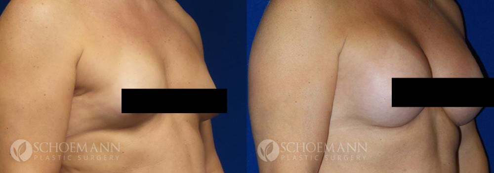 Schoemann-Plastic-Surgery_Encinitas_maletofemalebreastsurgery_censored2_0001_2