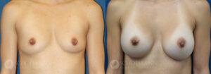 breast augmentation patient 12-4a