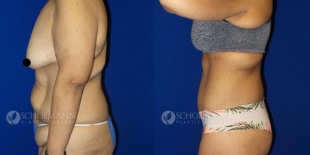 schoemann-plastic-surgery-encinitas-body-lift-patient-1-2-censored