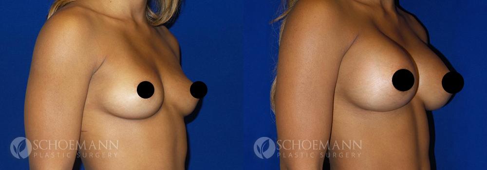 schoemann-plastic-surgery-encinitas-breast-augmentation-patient-1-2-censored