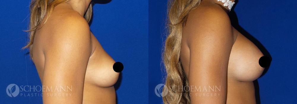 schoemann-plastic-surgery-encinitas-breast-augmentation-patient-1-3-censored