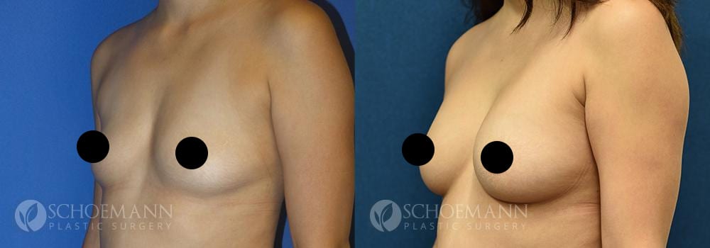 schoemann-plastic-surgery-encinitas-breast-augmentation-patient-11-2-censored