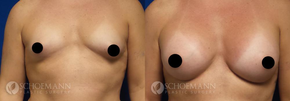 schoemann-plastic-surgery-encinitas-breast-augmentation-patient-9-1-censored