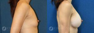 breast augmentation patient 12-2