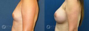 breast augmentation patient 13-1