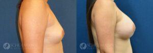 breast augmentation patient 13-2