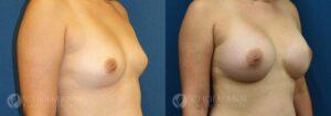 breast augmentation patient 13-3