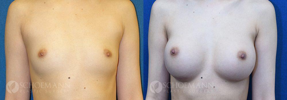 breast augmentation patient 14-3