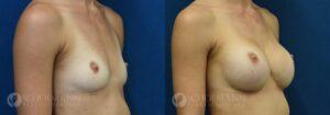 breast augmentation patient 15-3