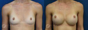 breast augmentation patient 15-4