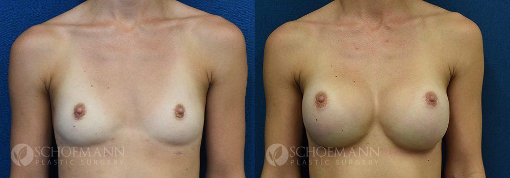 breast augmentation patient 15-4