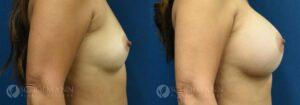 breast augmentation patient 16-2