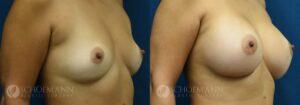 breast augmentation patient 16-3