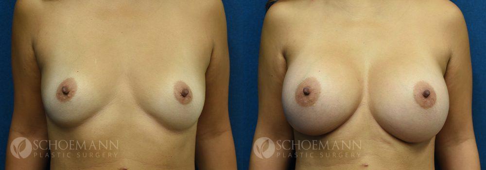 breast augmentation patient 16-4