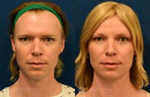 facial-feminization-ffs-patient-1-5