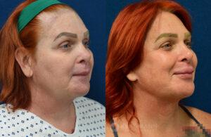 facial-feminization-ffs-patient-2-3